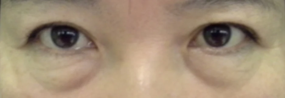 Before: Lower blepharoplasty for a woman in her 50s, one week after surgery