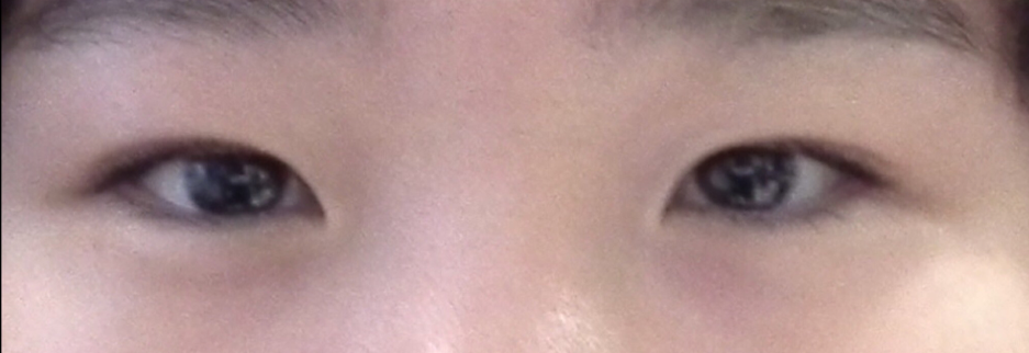 Before: Incisional ptosis correction with lateral canthoplasty, two months after surgery