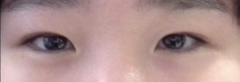 Before: Incisional double eyelid surgery with ptosis correction, two months after surgery
