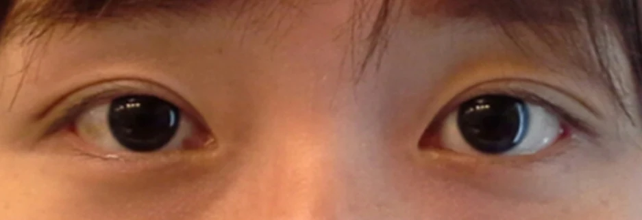 After: Non incisional double eyelid with ptosis correction, two weeks after surgery