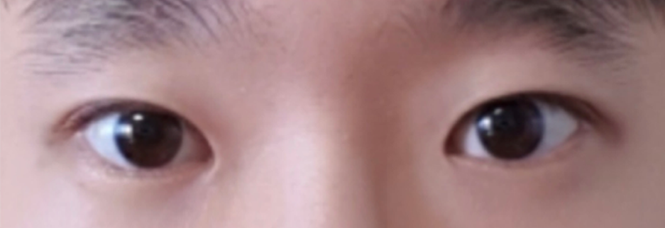 After: Men's incisional ptosis correction, two months after surgery