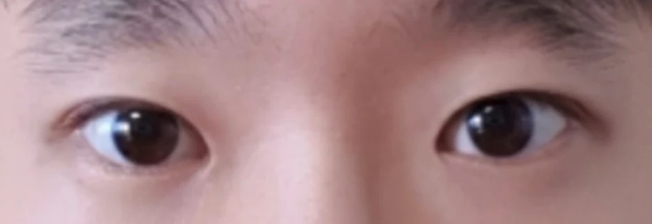 After: Men's incisional ptosis correction, two months after surgery