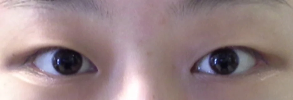 Before: Non incisional double eyelid with ptosis correction, one month after surgery