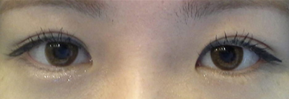 After: Revision surgery for a loosened fold, three months after surgery
