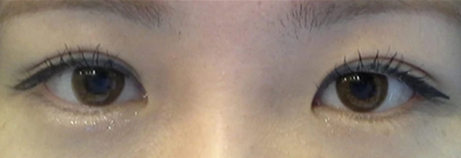 After: Revision surgery for a loosened fold, three months after surgery