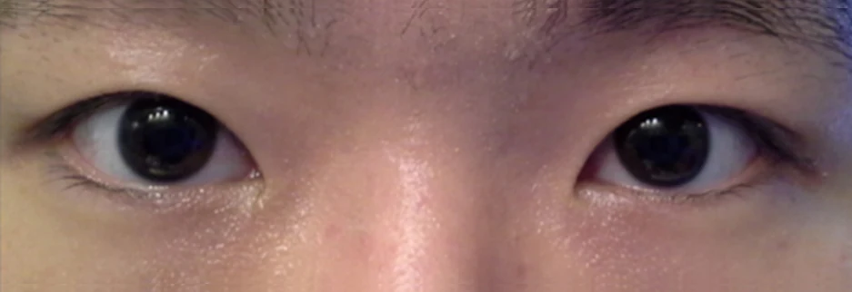 After: Men's incisional ptosis correction, two months after surgery