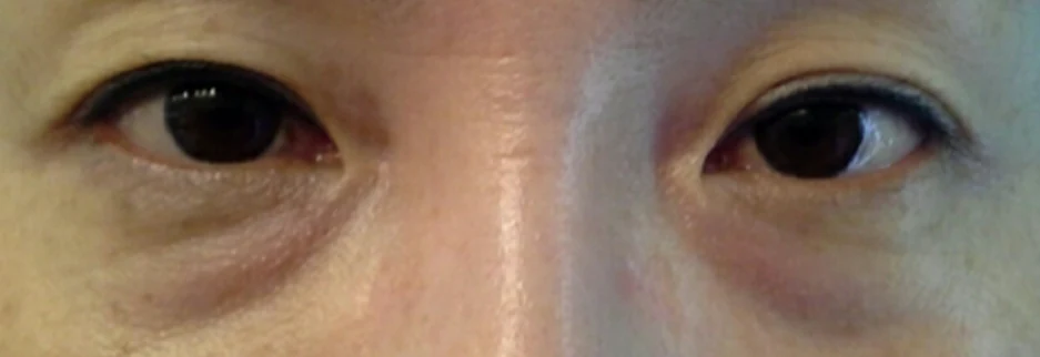 Before: Under eye fat repositioning, one month after surgery