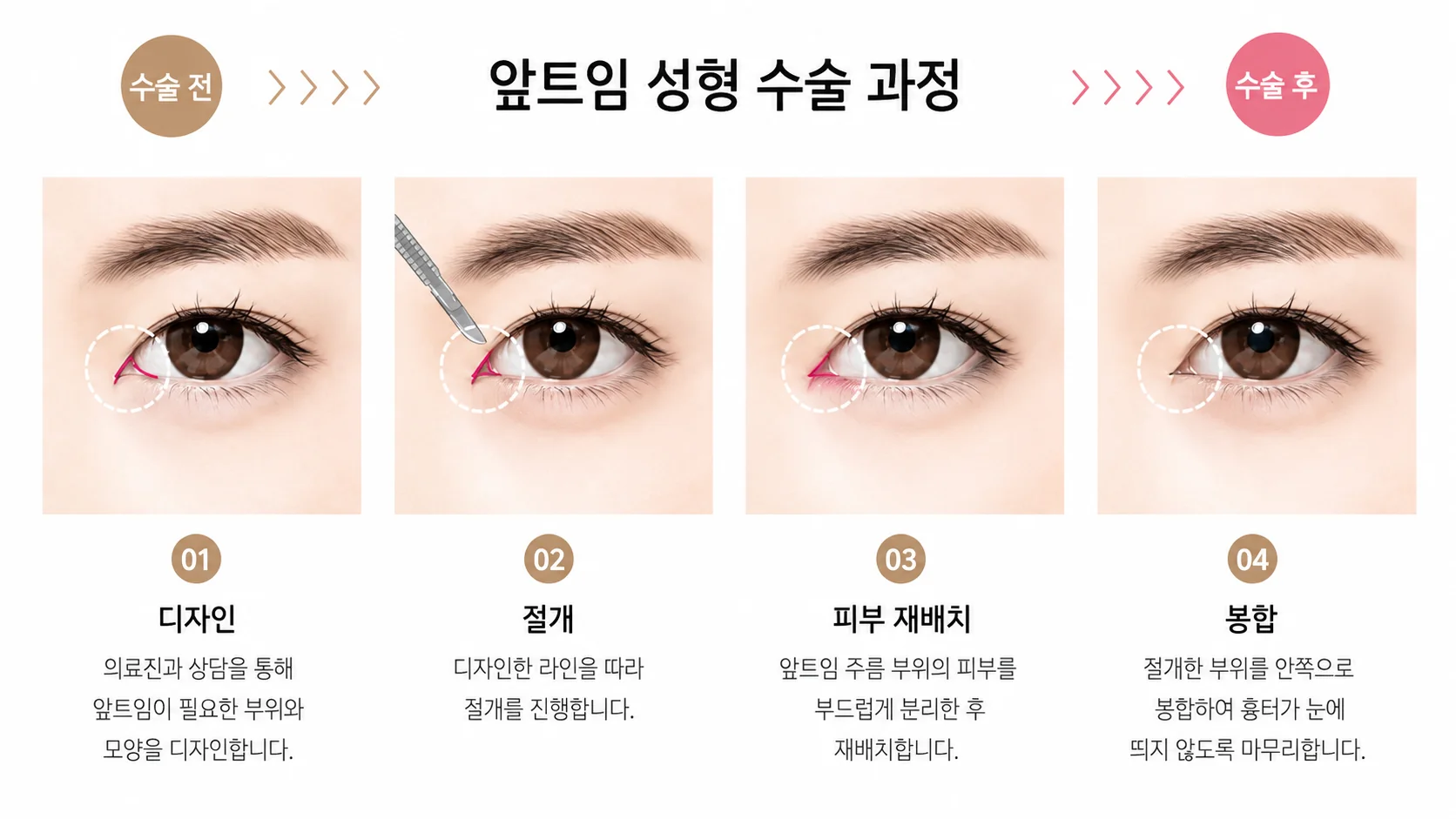 앞트임 4단계 일러스트: 눈 앞쪽 디자인, 라인을 따라 절개, 몽고주름 주변 피부 재배치, 흉터가 보이지 않도록 안쪽으로 봉합.