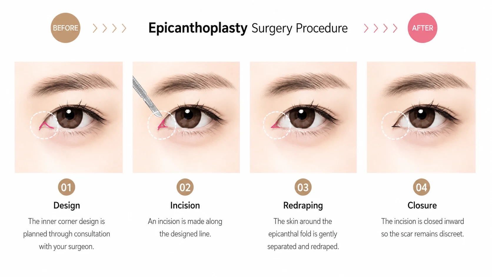 Four step illustration of epicanthoplasty: designing the inner corner, incision along the designed line, redraping the skin around the epicanthal fold, and closing inward so the scar stays discreet.