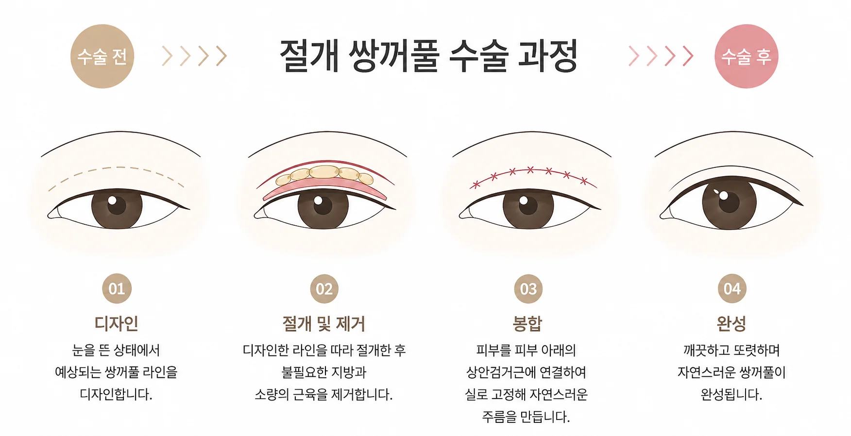 절개 쌍꺼풀수술 4단계 일러스트: 라인 디자인, 절개 후 불필요한 지방과 근육 일부 제거, 피부와 눈꺼풀올림근 봉합, 완성된 자연스러운 라인.