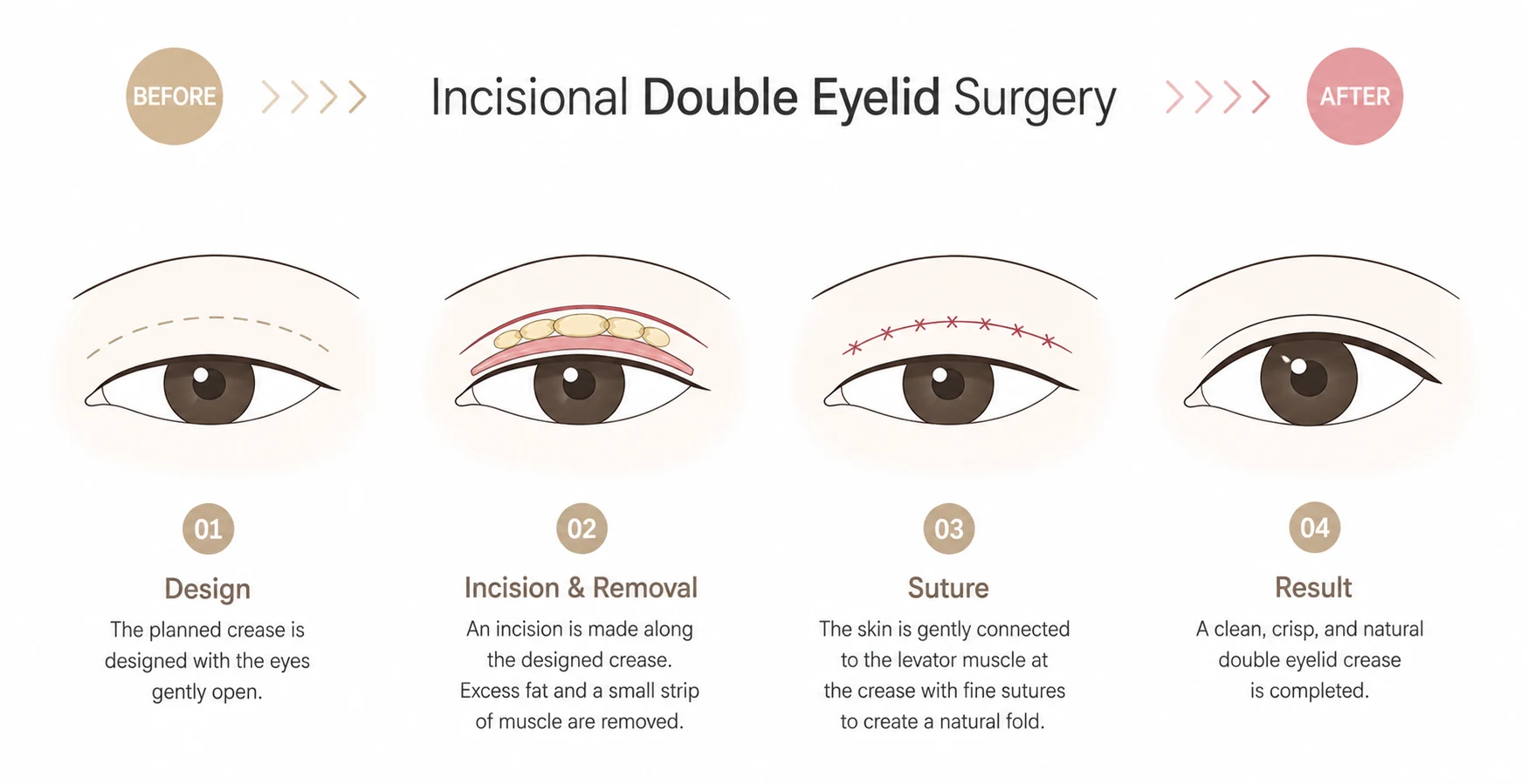 Four step illustration of incisional double eyelid surgery: designing the crease, incision with removal of excess fat and a strip of muscle, suturing the skin to the levator muscle, and the finished natural crease.