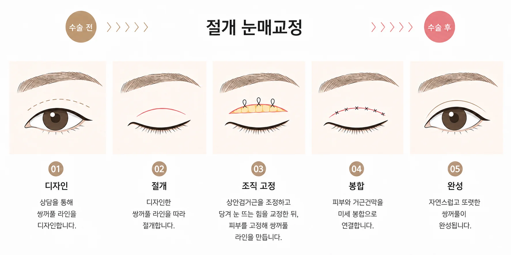 절개 눈매교정 5단계 일러스트: 라인 디자인, 절개, 눈꺼풀올림근 강화, 피부와 근막 봉합, 완성된 밝은 눈.