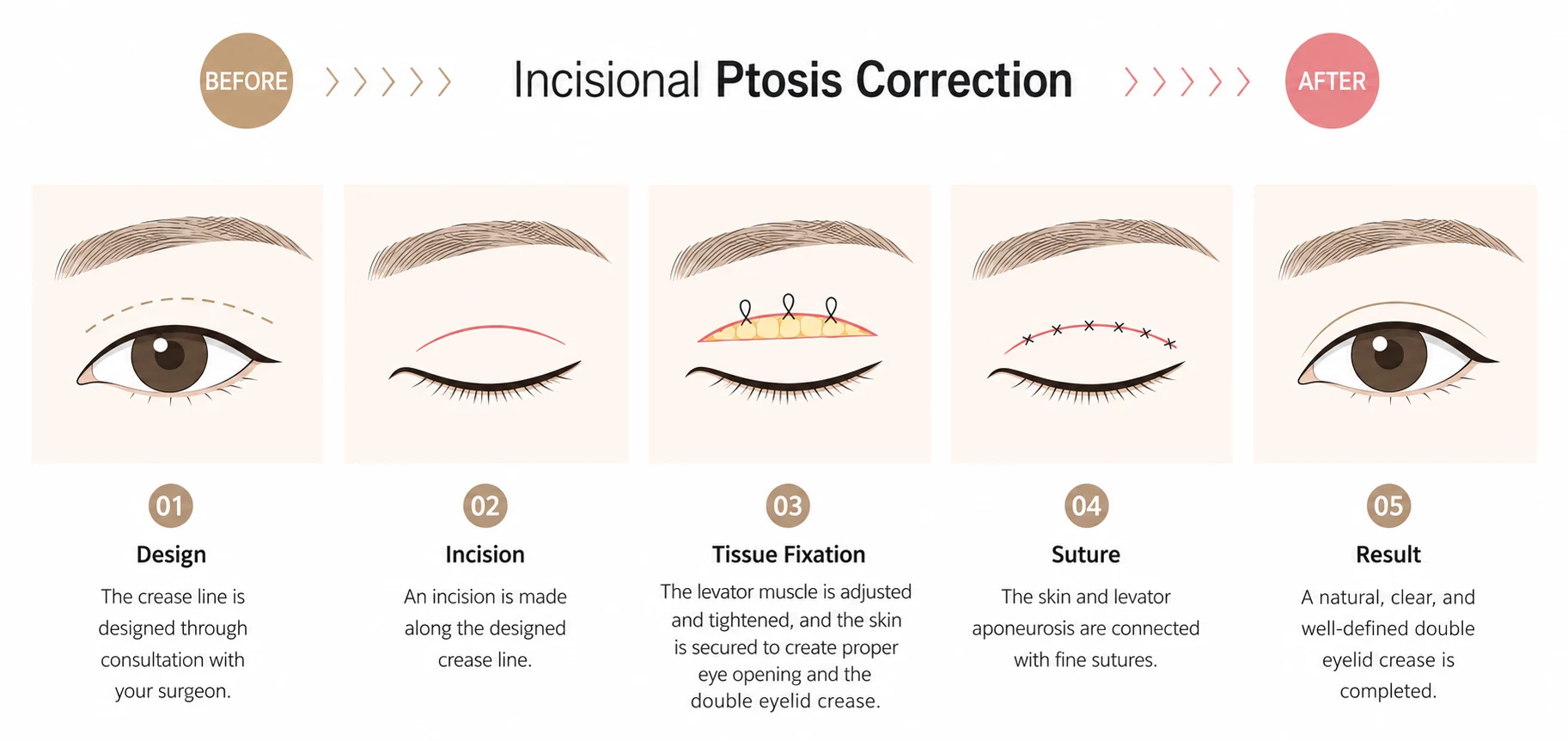 Five step illustration of incisional ptosis correction: designing the crease, incision, tightening the levator muscle, suturing skin to the levator aponeurosis, and the finished brighter eye.