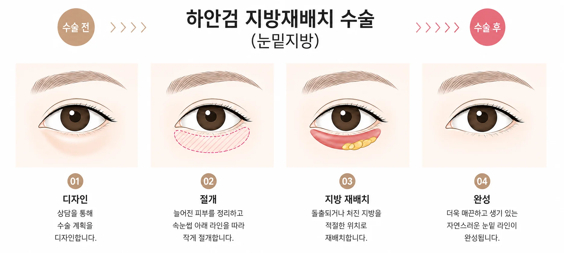 하안검수술 4단계 일러스트: 계획 디자인, 속눈썹 라인 절개로 여분 피부 제거, 튀어나온 지방 재배치, 완성된 매끈한 눈밑 라인.