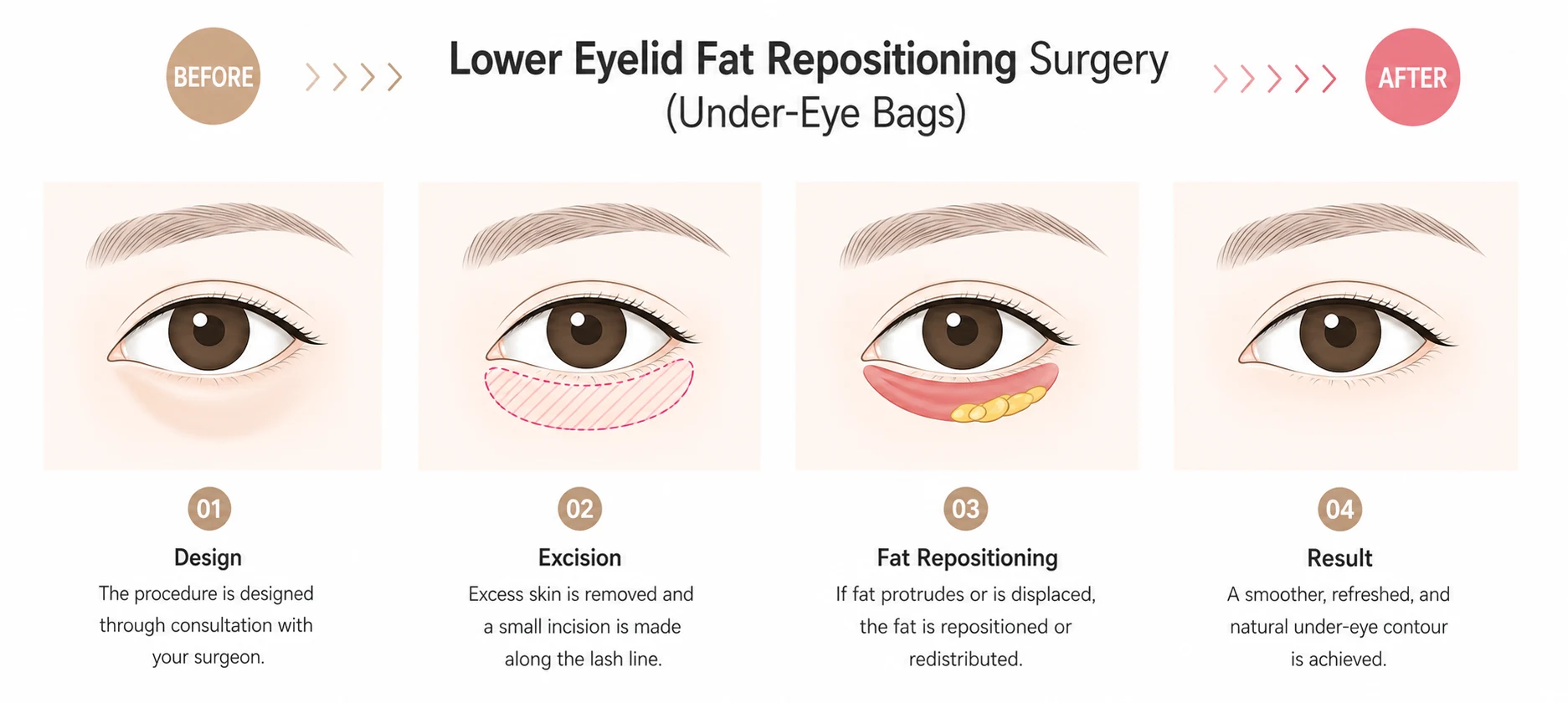 Four step illustration of lower blepharoplasty: designing the plan, removing excess skin through an incision along the lash line, repositioning or redistributing protruding fat, and the finished smooth under eye contour.