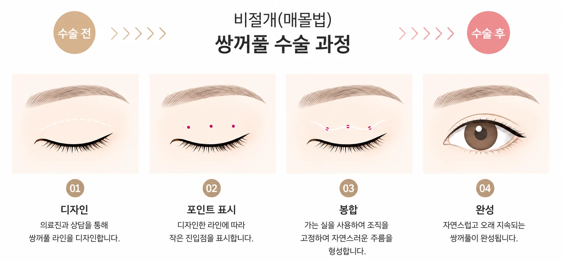 비절개 쌍꺼풀수술 4단계 일러스트: 라인 디자인, 미세 구멍 표시, 매몰 봉합으로 조직 고정, 완성된 자연스러운 라인.