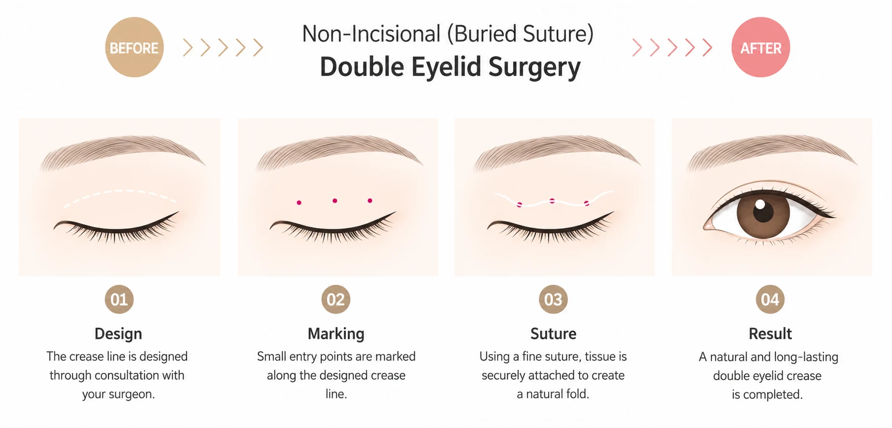 Four step illustration of non incisional double eyelid surgery: designing the crease, marking small entry points, fixing the tissue with a buried suture, and the finished natural crease.