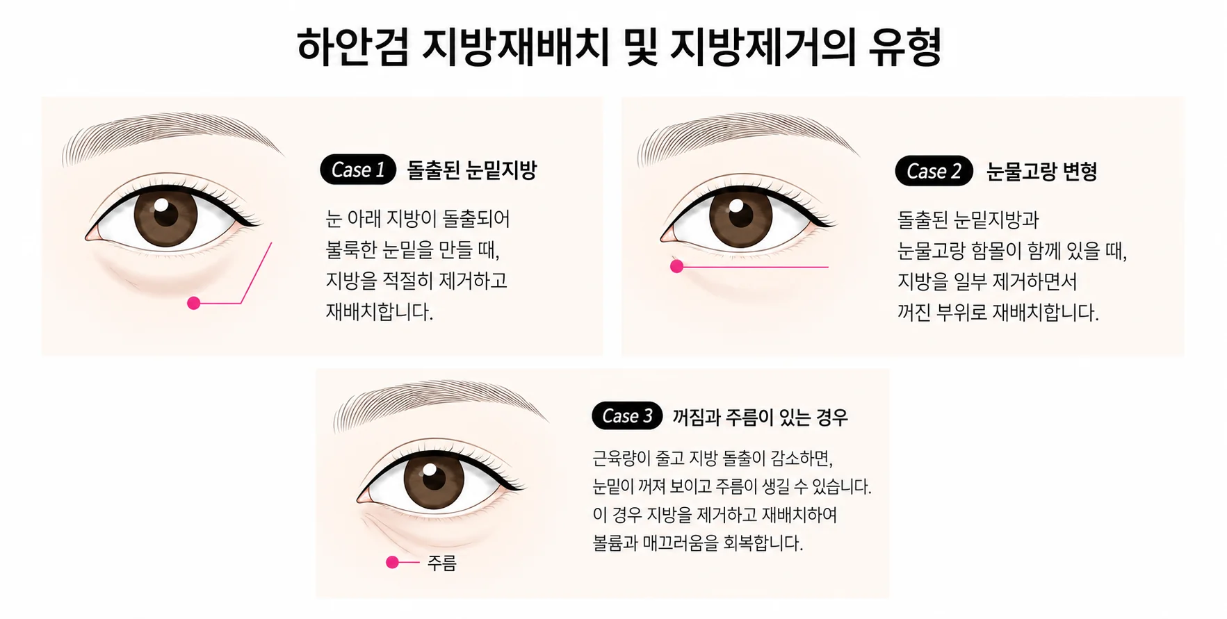 눈밑 지방 3가지 유형 일러스트: 튀어나온 눈밑 지방, 눈물고랑 함몰, 꺼짐과 주름 동반, 그리고 각 유형별 지방 제거·재배치 방법.