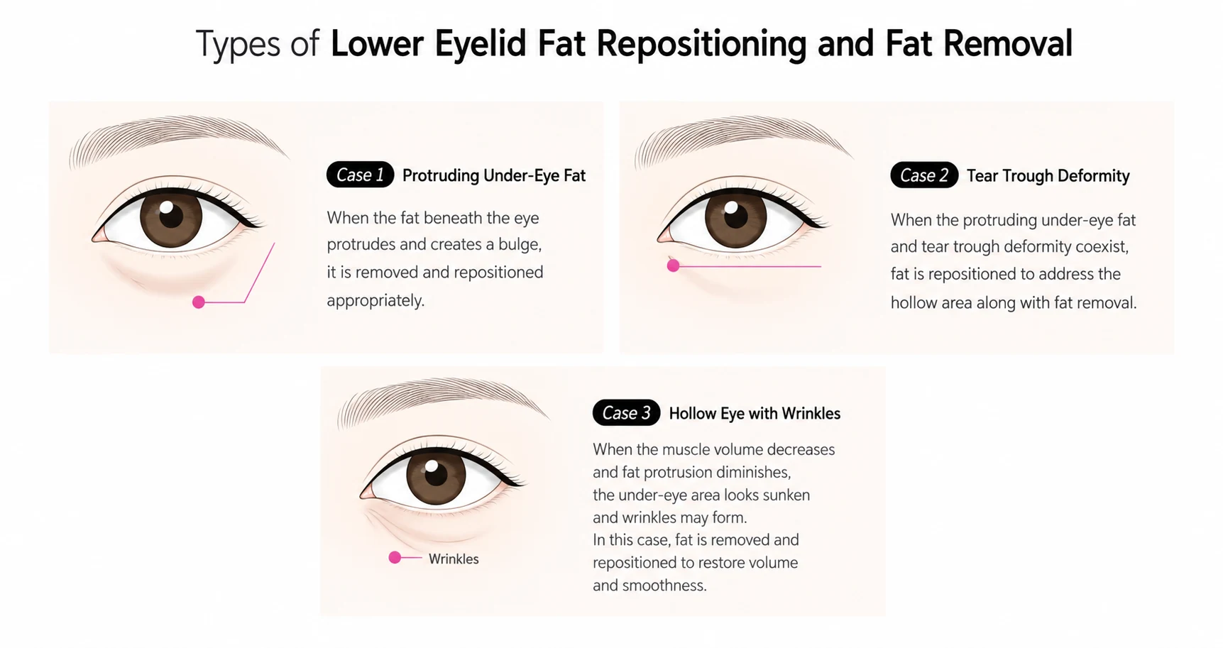 Illustration of three under eye fat cases: protruding under eye fat, tear trough deformity, and hollow eye with wrinkles, and how fat removal and repositioning addresses each.
